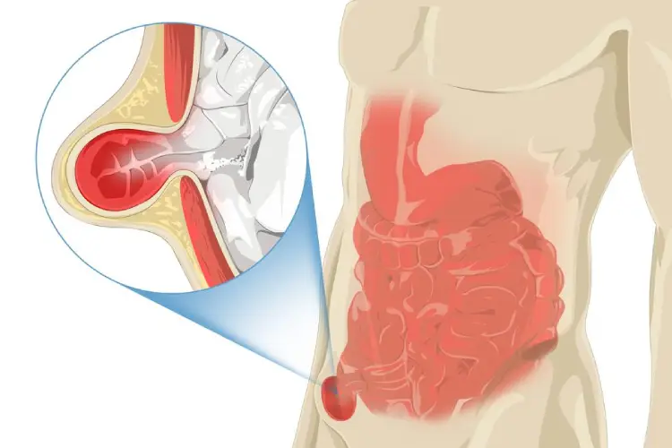 precio de cirugía de hernia inguinal en Guadalajara