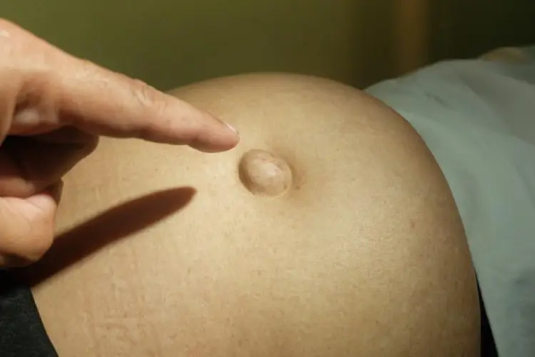 precio de cirugía de hernia inguinal en Guadalajara