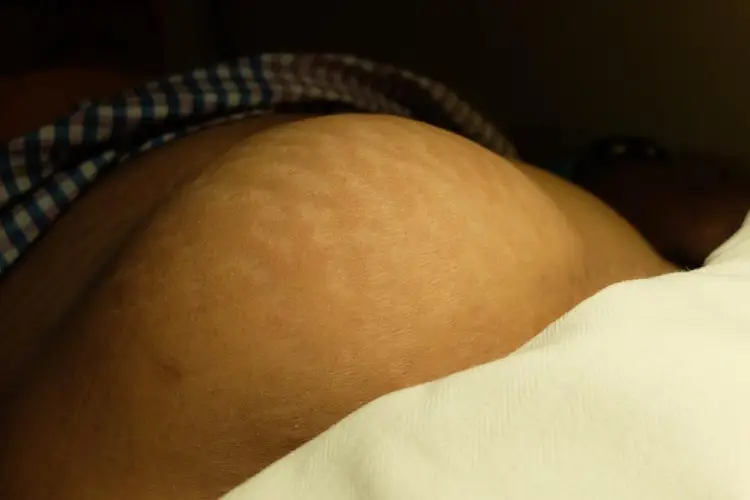 Precio de Cirugía de hernia ventral en Guadalajara