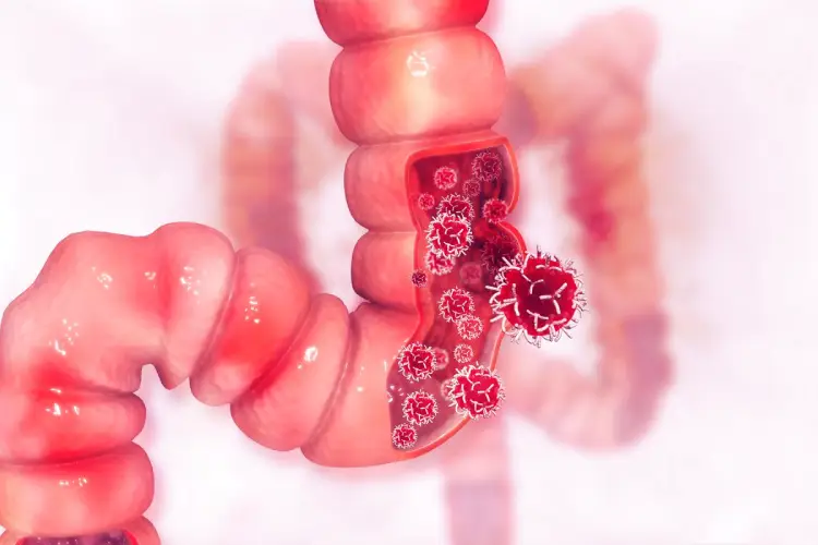 precio de cirugía para cáncer de colon y recto en Guadalajara